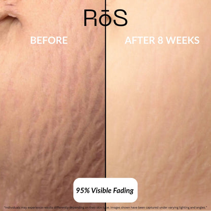 StretchFix Pro™ — Advanced Stretch Mark Repair Kit