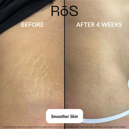 StretchFix Pro™ — Advanced Stretch Mark Repair Kit