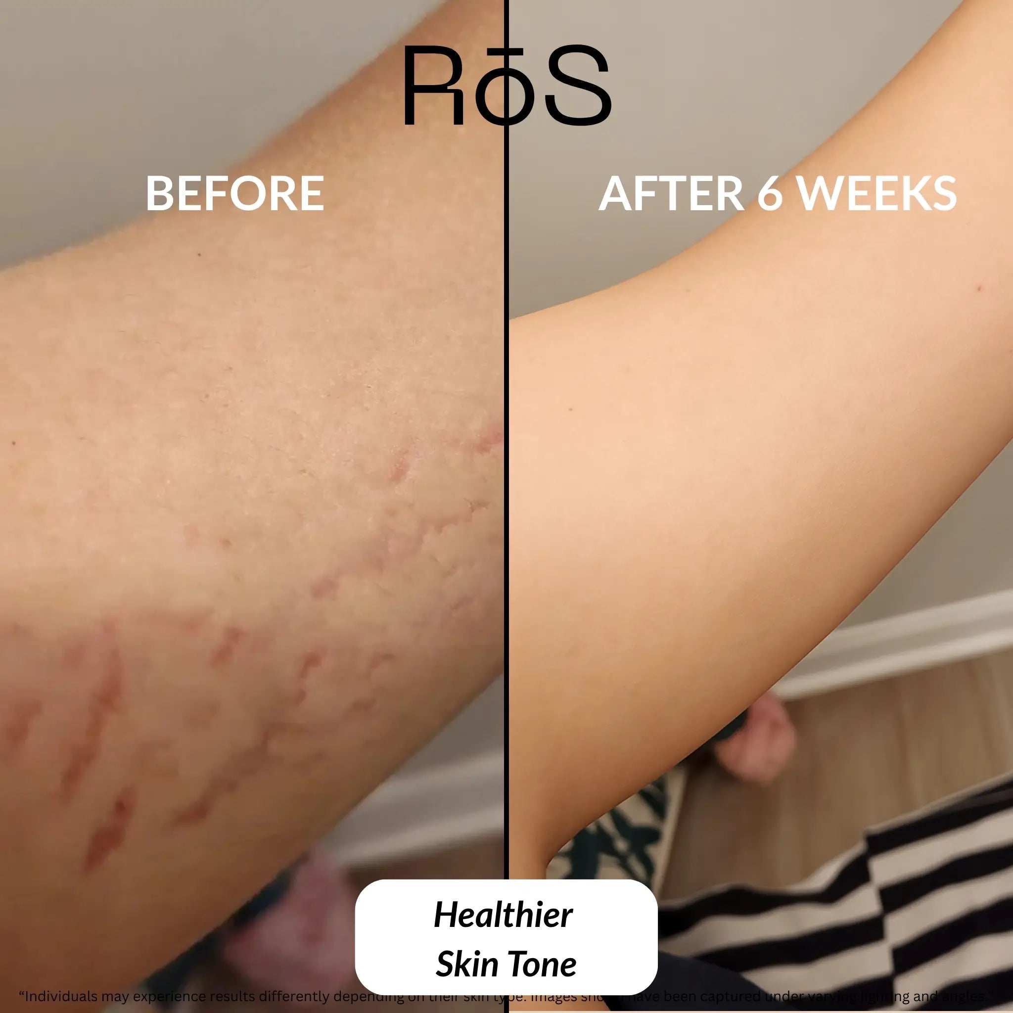 StretchFix Pro™ — Advanced Stretch Mark Repair Kit