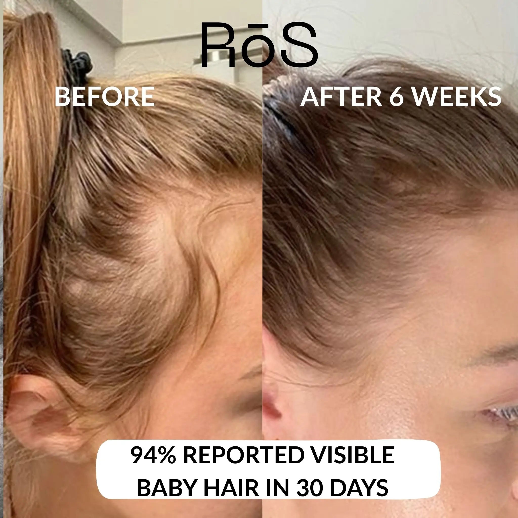 RōS Hair Regrowth Solution