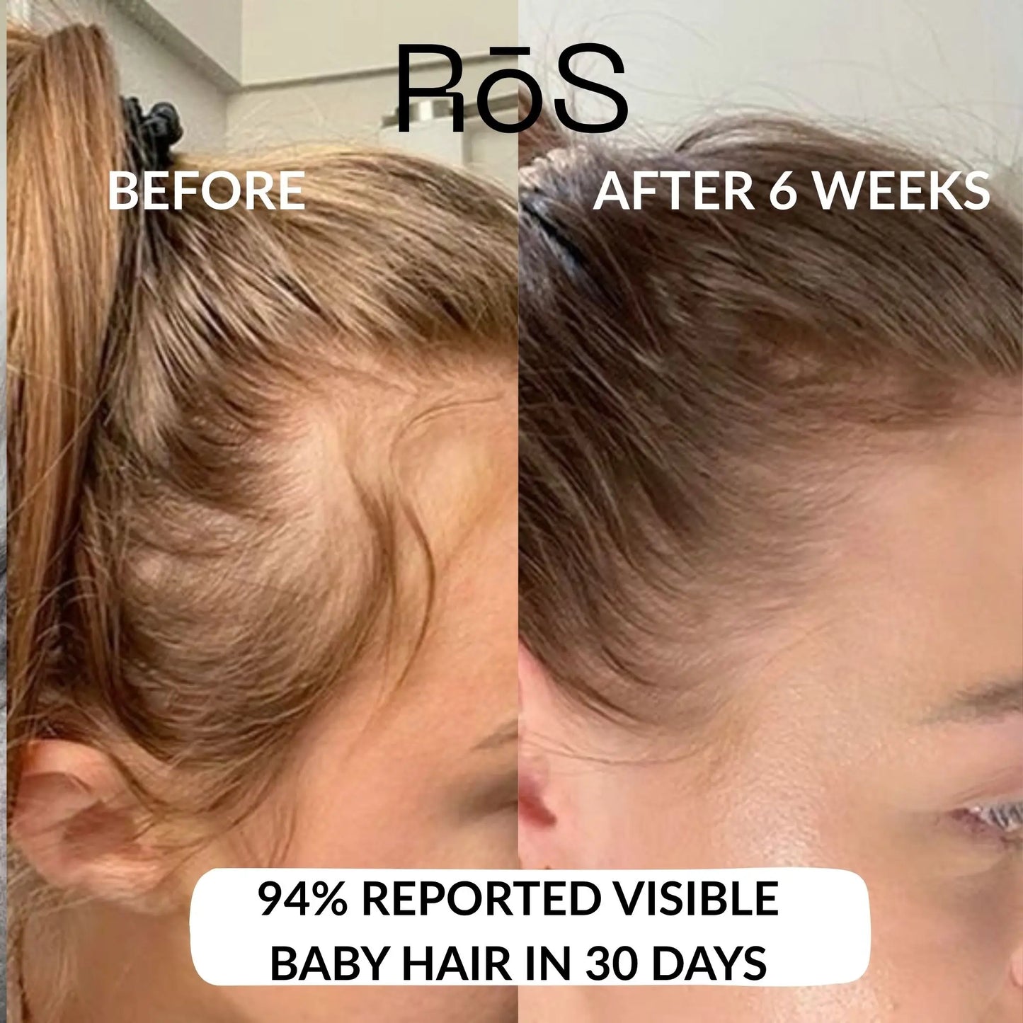 RōS Hair Regrowth Solution