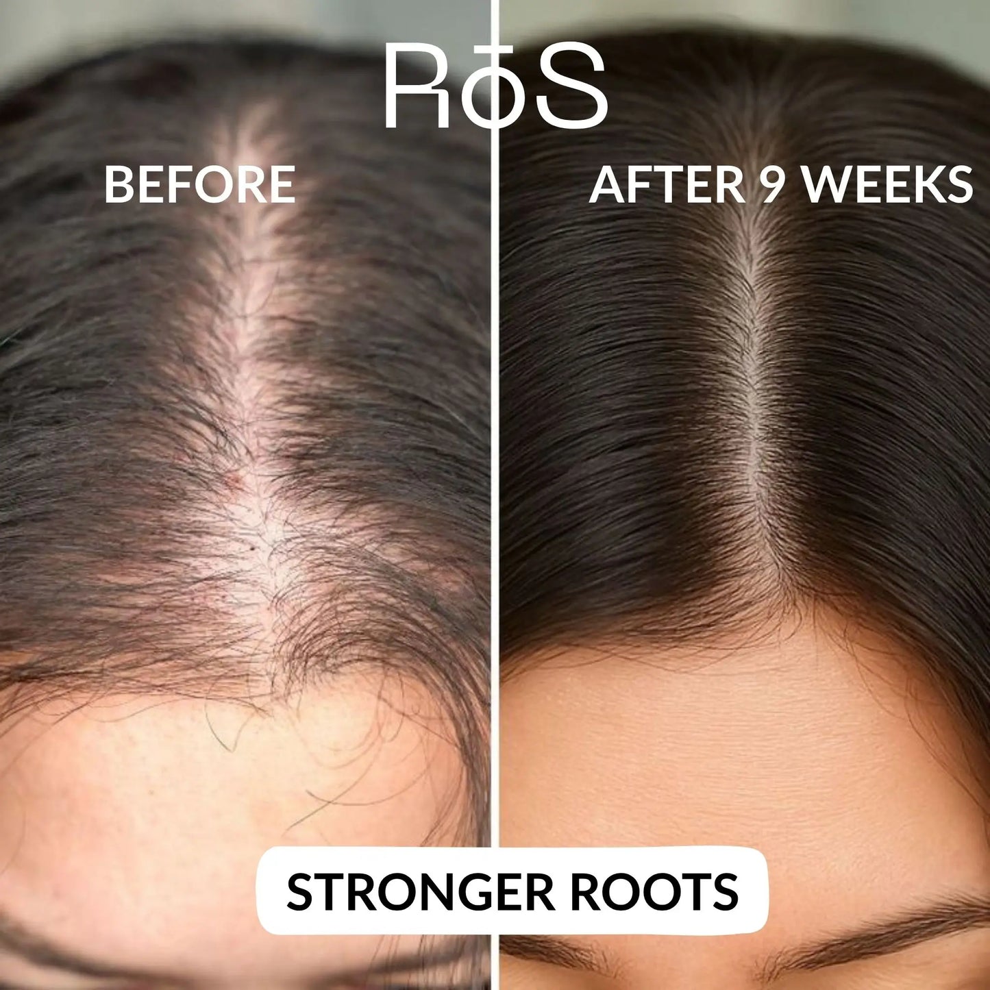 RōS Hair Regrowth Solution